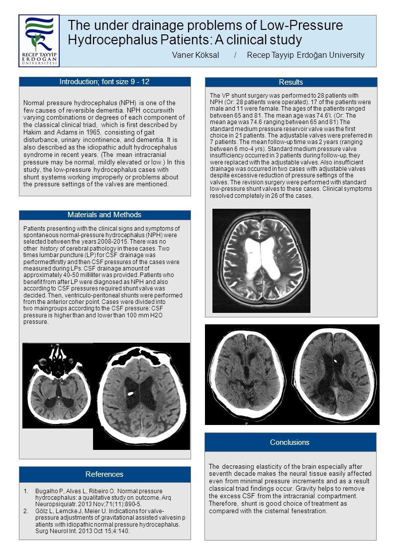The under drainage problems of Low-Pressure Hydrocephalus Patients: A clinical study Vaner Köksal /Recep Tayyip Erdoğan University Introduction; font size Normal pressure hydrocephalus (NPH) is one of the few causes of reversible dementia.