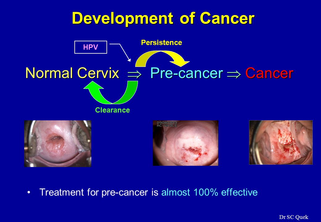 hpv pre cancer treatment