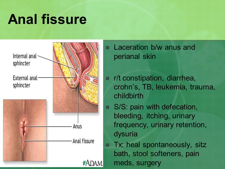 Check out the surgical options for treating anal fissures