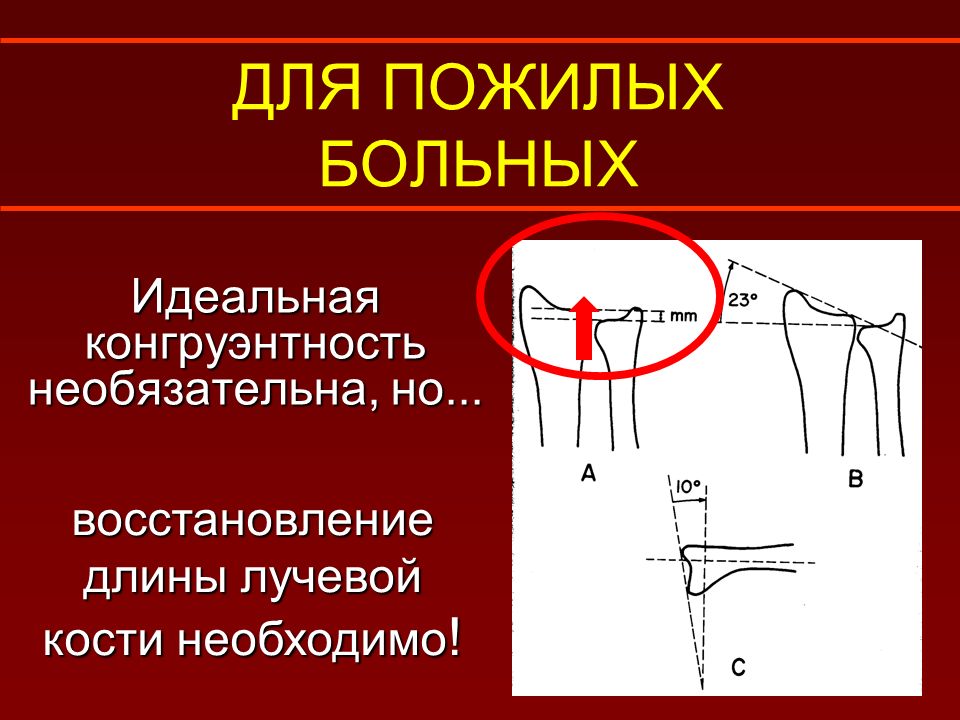 Перелом дистального метаэпифиза лучевой кости со смещением