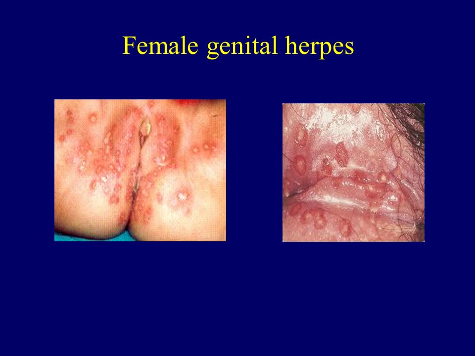 Female genital herpes.