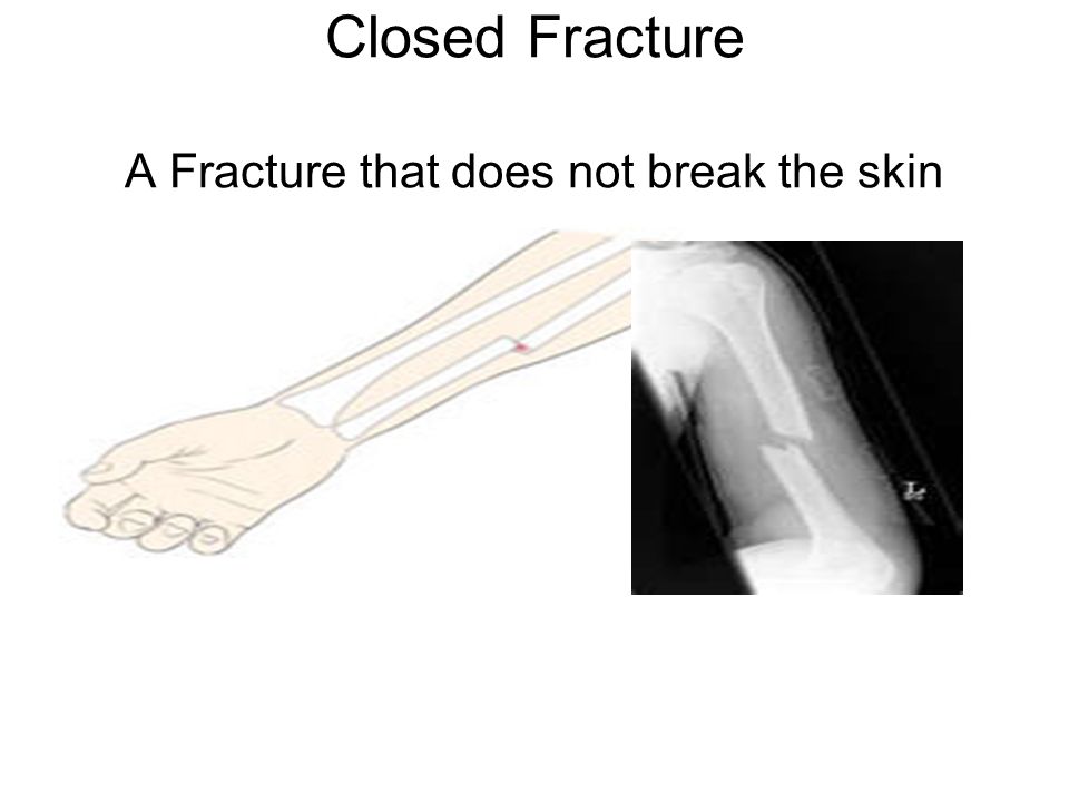 Closed Fracture A Fracture that does not break the skin