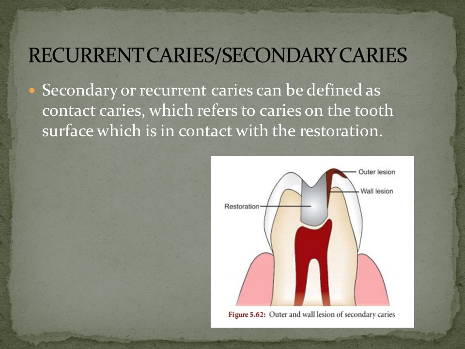 secondary caries