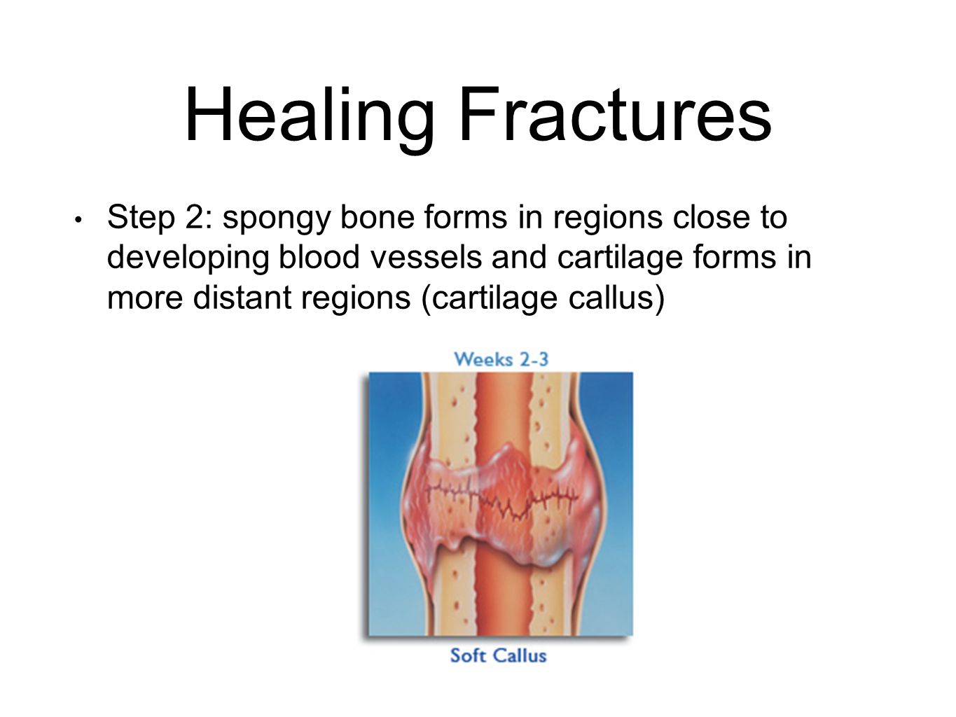 Healing Fractures Step 2: spongy bone forms in regions close to developing blood vessels and cartilage forms in more distant regions (cartilage callus)