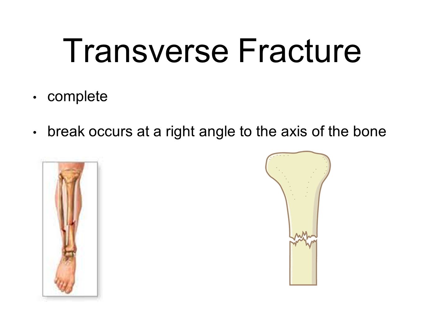 Transverse Fracture complete break occurs at a right angle to the axis of the bone