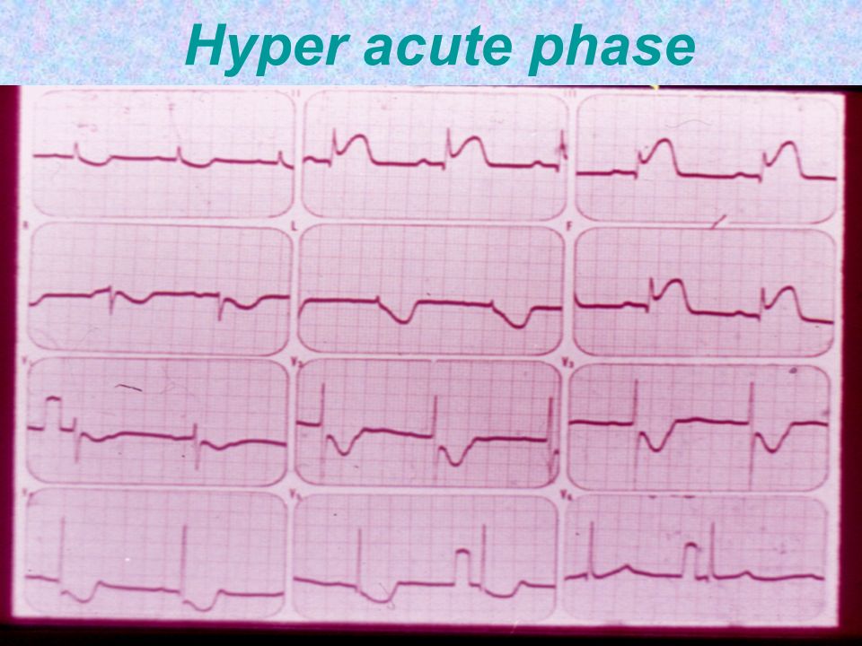 Hyper acute phase