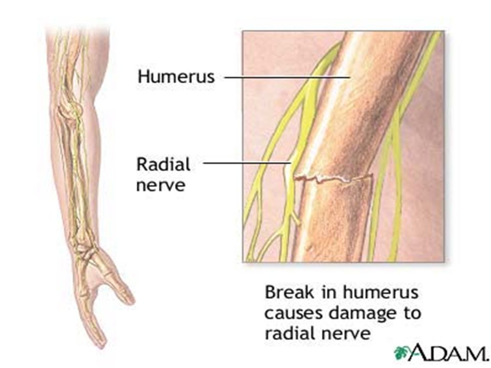 Невропатия лучевого нерва мкб. Повреждение лучевого нерва при переломе. Повреждение лучевого нерва при переломе лучевой кости. Повреждения лучевого нерва при переломе плеча. Повреждение лучевого нерва при переломе плечевой кости.