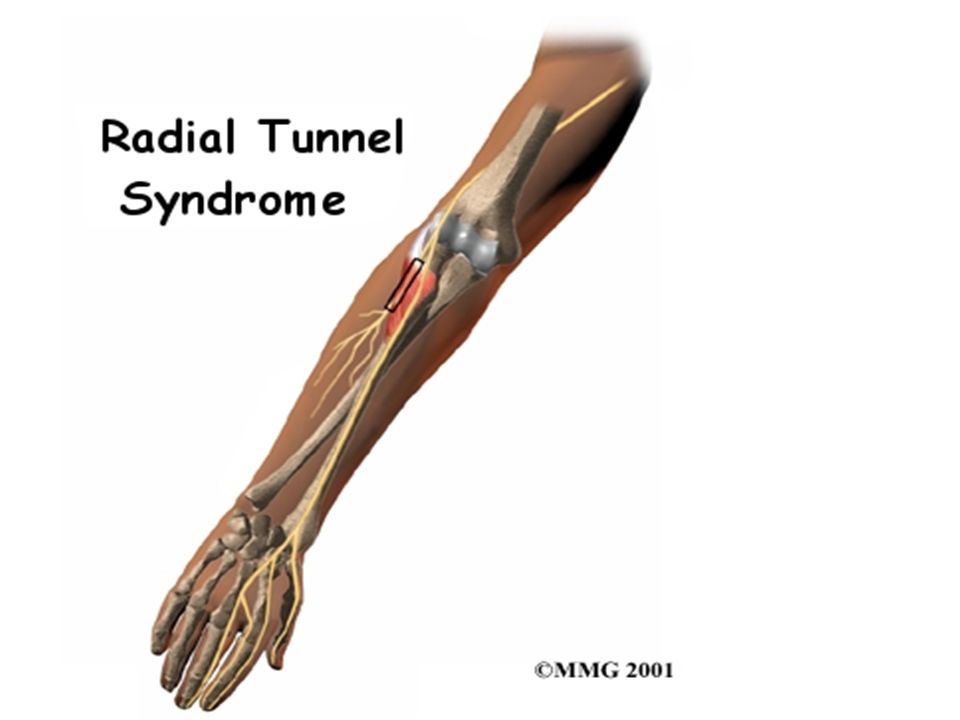 Нейропатия локтевого нерва мкб. Кубитальный туннельный синдром. Лучевой туннельный синдром. Радиальный туннельный синдром локтя. Туннельный синдром лучевого нерва.