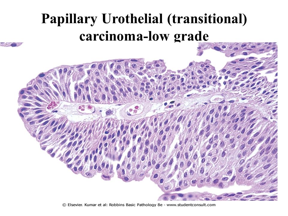 benign papillary urothelial