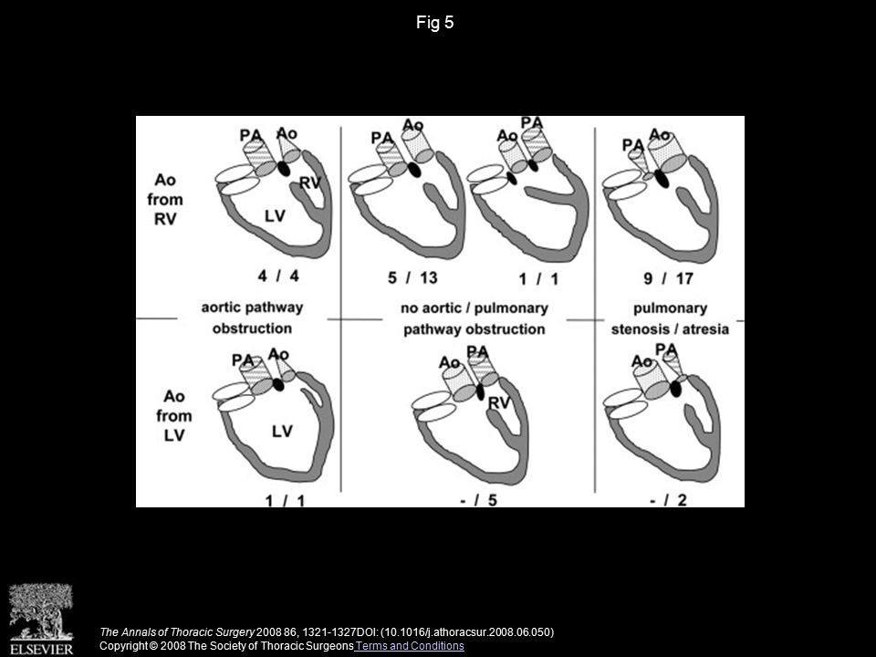Fig 5 The Annals of Thoracic Surgery , DOI: ( /j.athoracsur ) Copyright © 2008 The Society of Thoracic Surgeons Terms and Conditions Terms and Conditions