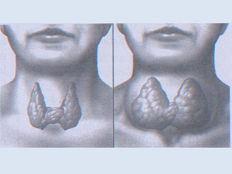 Нетоксический зоб щитовидной. Эутиреоидный зоб. Фиброзный тиреоидит Риделя. Эндемический зоб щитовидной. Узловой эндемический зоб.