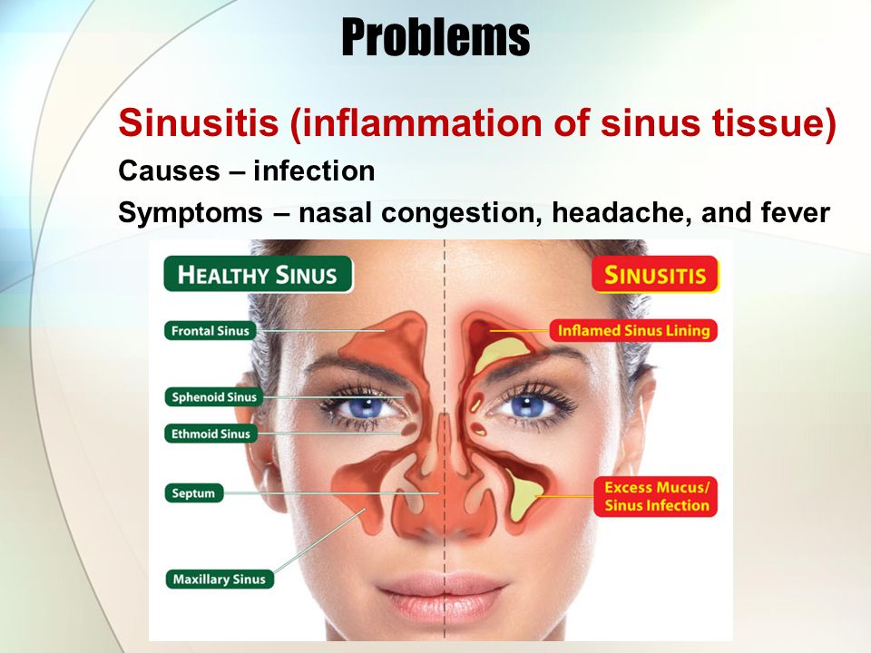 Problems Sinusitis (inflammation of sinus tissue) Causes - infection Sympto...