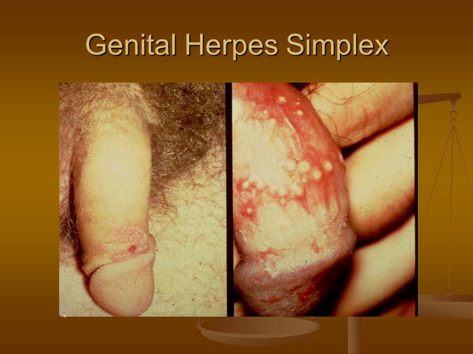 "STDs of Concern "Sores" (ulcers) "Sores" (ulcers)...