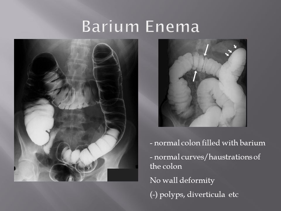 - normal colon filled with barium - normal curves/haustrations of the colon No wall deformity (-) polyps, diverticula etc