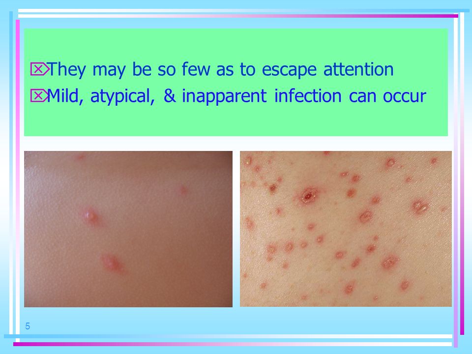 pix Chicken Pox Rash Stages chicken pox 2 instructional objectives