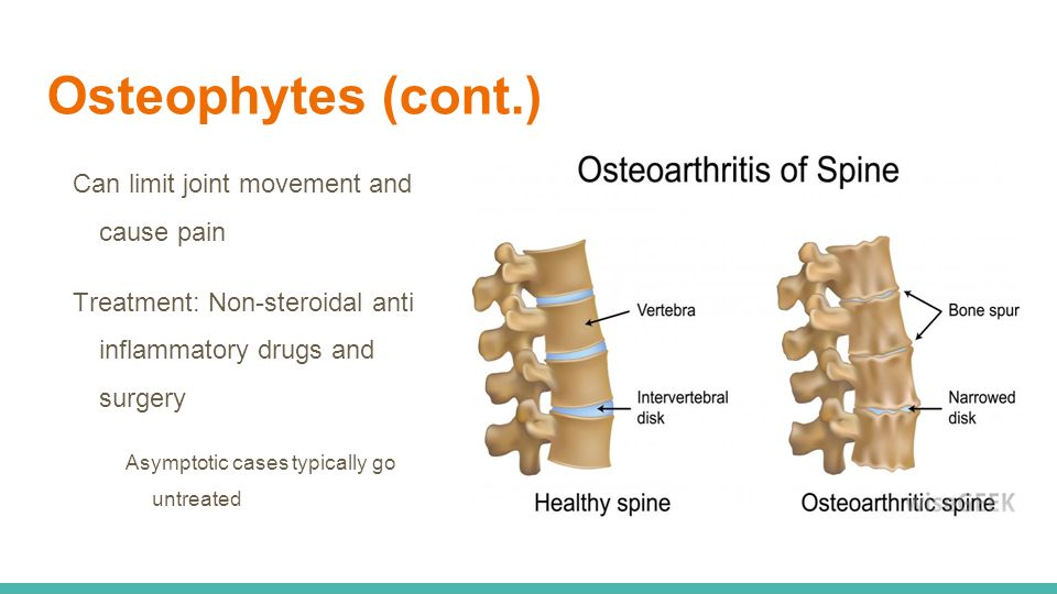 Osteophytes (cont.) Can limit joint movement and cause pain Treatment: Non-steroidal anti inflammatory drugs and surgery Asymptotic cases typically go untreated