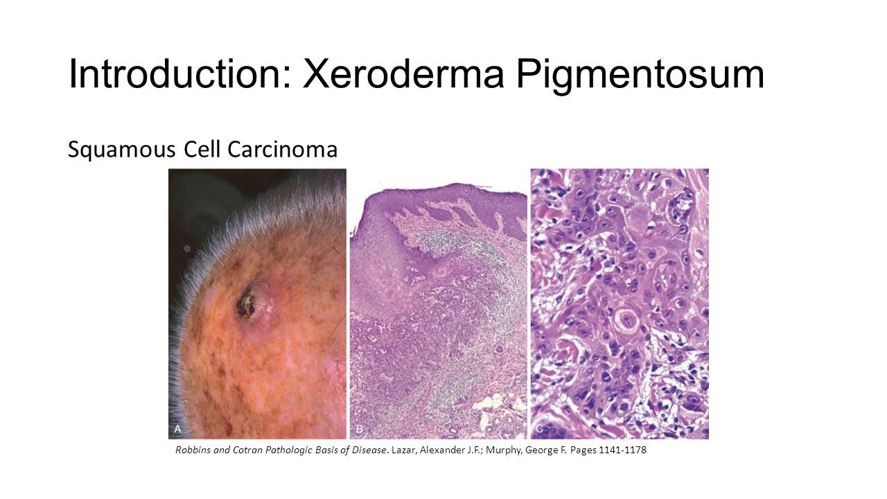 Xeroderma pigmentosa: causes and treatment 32 Xeroderma pigmentosa: causes and treatment 68