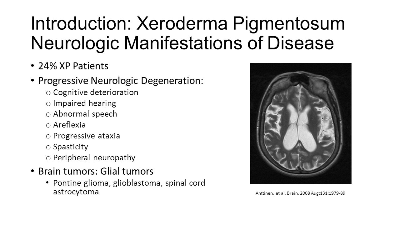 Xeroderma pigmentosa: causes and treatment 88 Xeroderma pigmentosa: causes and treatment 26