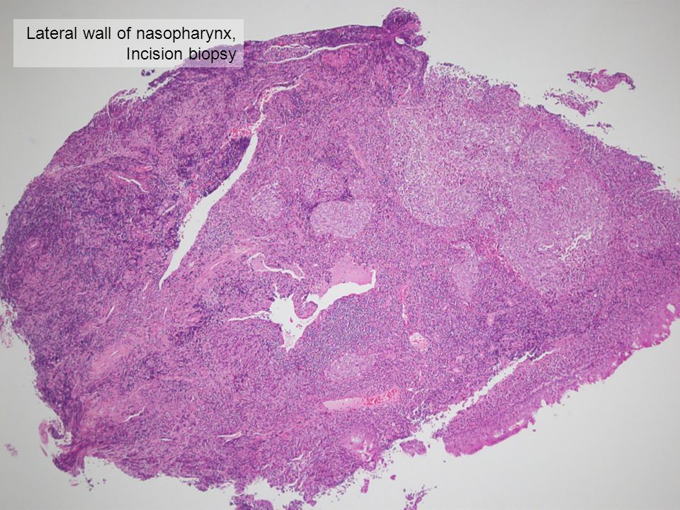 Lateral wall of nasopharynx, Incision biopsy