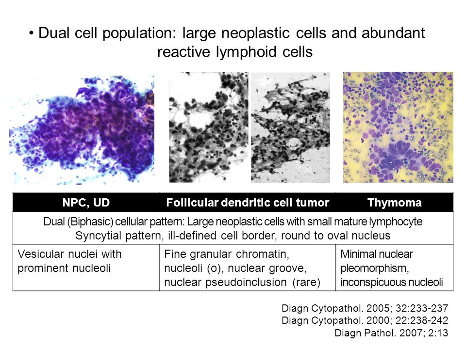 Dual cell population: large neoplastic cells and abundant reactive lymphoid cells NPC, UDFollicular dendritic cell tumorThymoma Dual (Biphasic) cellular pattern: Large neoplastic cells with small mature lymphocyte Syncytial pattern, ill-defined cell border, round to oval nucleus Vesicular nuclei with prominent nucleoli Fine granular chromatin, nucleoli (o), nuclear groove, nuclear pseudoinclusion (rare) Minimal nuclear pleomorphism, inconspicuous nucleoli Diagn Cytopathol.