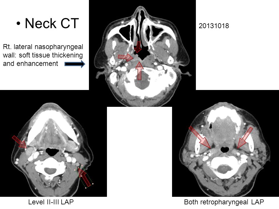 Neck CT Level II-III LAPBoth retropharyngeal LAP Rt.
