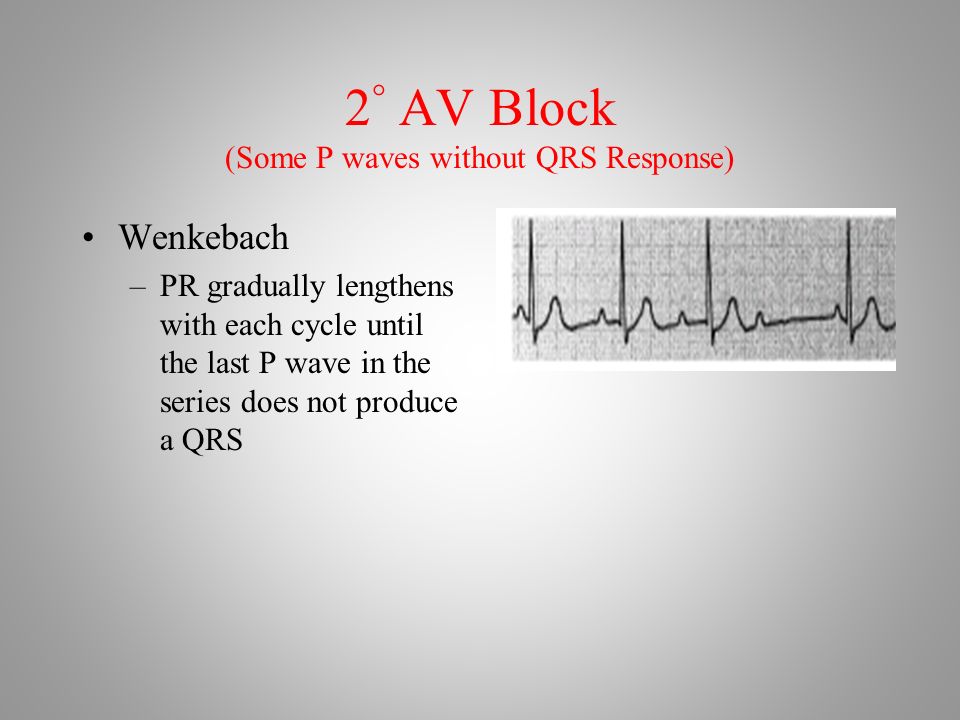 2 ° AV Block (Some P waves without QRS Response) Wenkebach –PR gradually lengthens with each cycle until the last P wave in the series does not produce a QRS