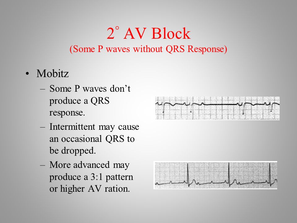 2 ° AV Block (Some P waves without QRS Response) Mobitz –Some P waves don’t produce a QRS response.