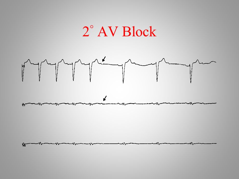 2 ° AV Block