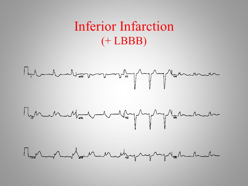 Inferior Infarction (+ LBBB)