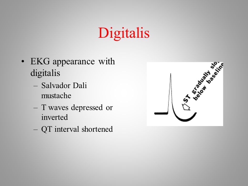 Digitalis EKG appearance with digitalis –Salvador Dali mustache –T waves depressed or inverted –QT interval shortened