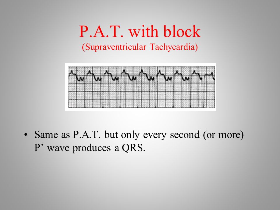 P.A.T. with block (Supraventricular Tachycardia) Same as P.A.T.