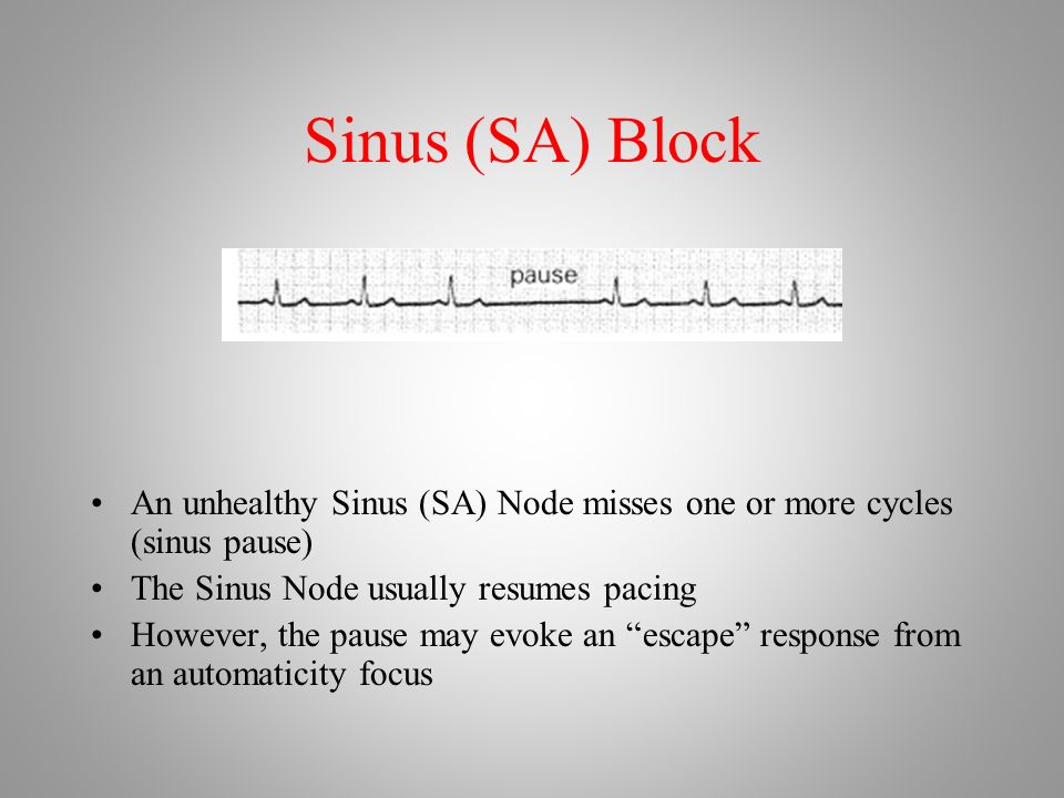 Sinus (SA) Block An unhealthy Sinus (SA) Node misses one or more cycles (sinus pause) The Sinus Node usually resumes pacing However, the pause may evoke an escape response from an automaticity focus