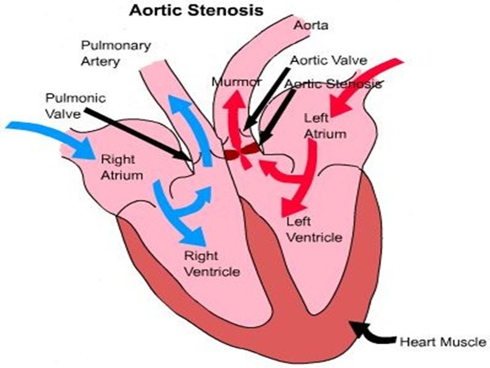 Давление крови в правом предсердии. Правое предсердие анатомия. Легкое давит на правое предсердие. Bicuspid Aortic Valve classification.