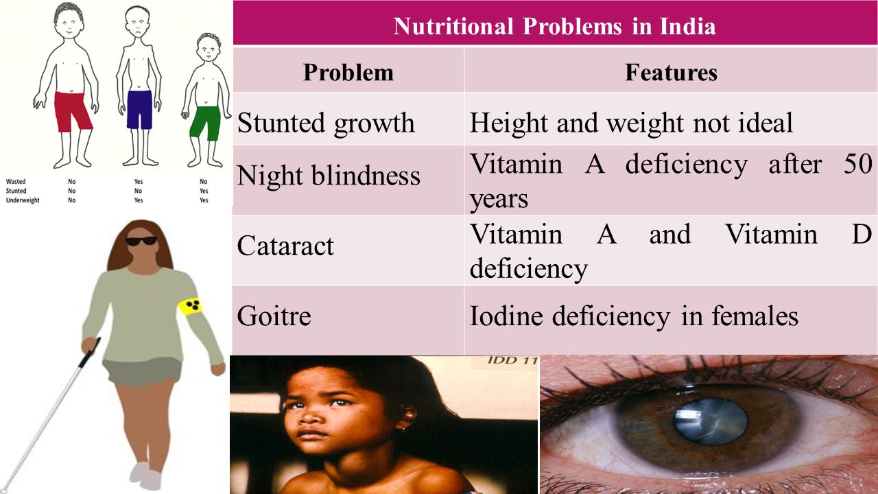 NUTRITIONAL PROBLEMS IN INDIA Nutritional Problems in India ProblemFeatures Stunted growthHeight and weight not ideal Night blindness Vitamin A deficiency after 50 years Cataract Vitamin A and Vitamin D deficiency GoitreIodine deficiency in females