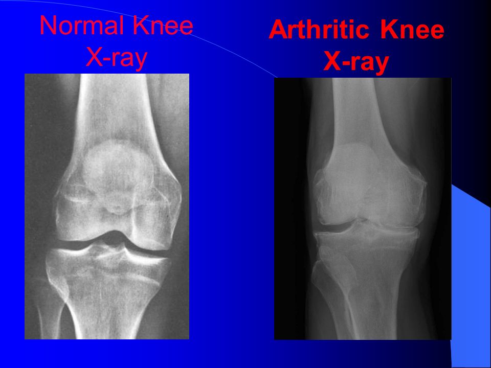Normal Knee X-ray Arthritic Knee X-ray.