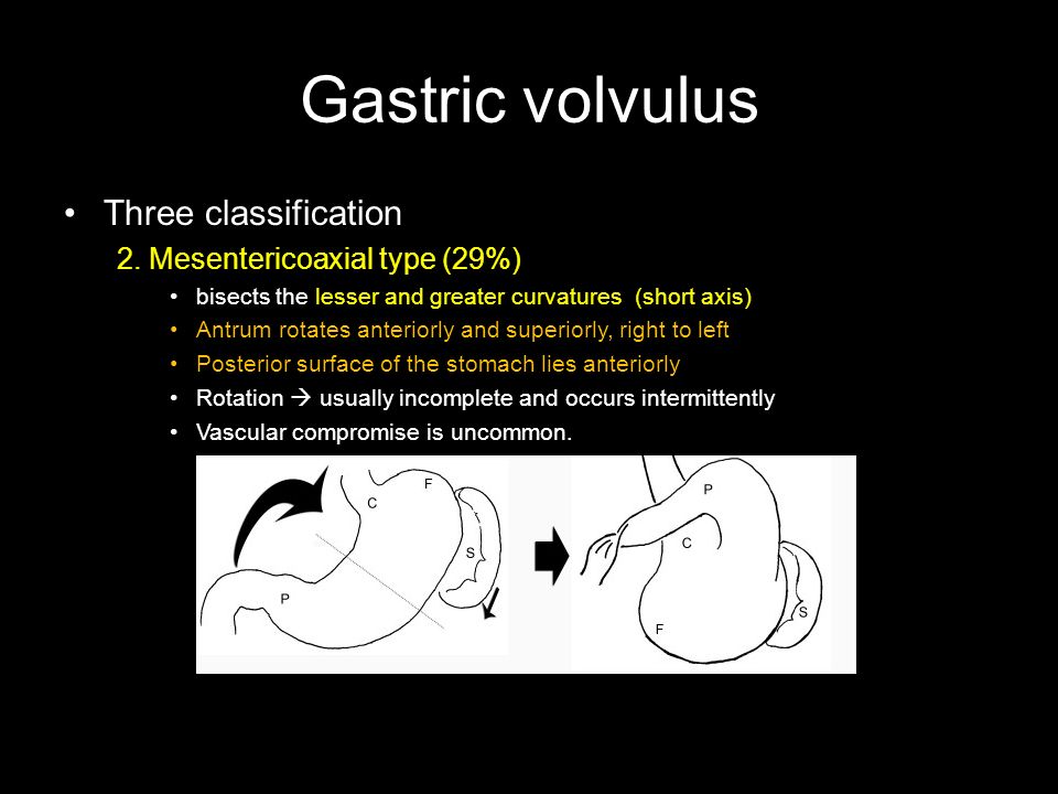 Gastric volvulus Three classification 2.