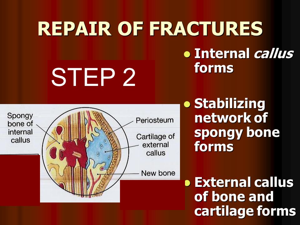 REPAIR OF FRACTURES Internal callus forms Internal callus forms Stabilizing network of spongy bone forms Stabilizing network of spongy bone forms External callus of bone and cartilage forms External callus of bone and cartilage forms STEP 2..