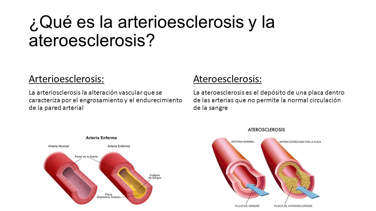 Resultado de imagen de arterioesclerosis y ateroesclerosis