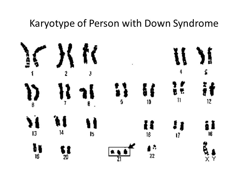 Набор дауна. Синдром Дауна кариотип. Синдром Дауна хромосомный набор кариотип. Набор хромосом у Дауна кариотип. Кариограмма синдрома Дауна.