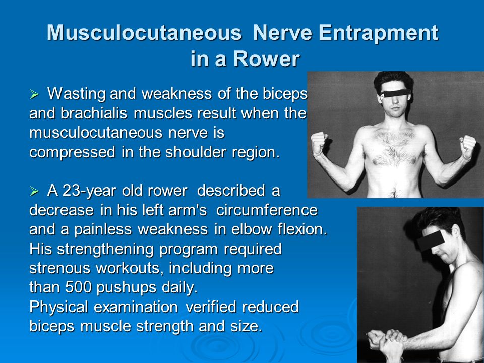 Musculocutaneous Nerve Entrapment in a Rower  Wasting and weakness of the biceps and brachialis muscles result when the musculocutaneous nerve is compressed in the shoulder region.