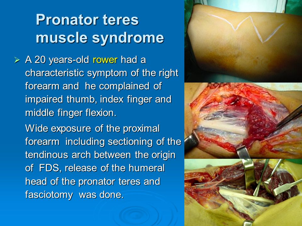 Pronator teres muscle syndrome  A 20 years-old rower had a characteristic symptom of the right forearm and he complained of impaired thumb, index finger and middle finger flexion.