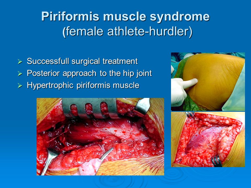 Piriformis muscle syndrome ( female athlete-hurdler)  Successfull surgical treatment  Posterior approach to the hip joint  Hypertrophic piriformis muscle