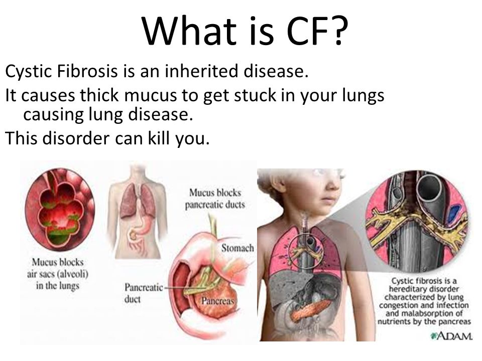 Is cf what Cystic Fibrosis