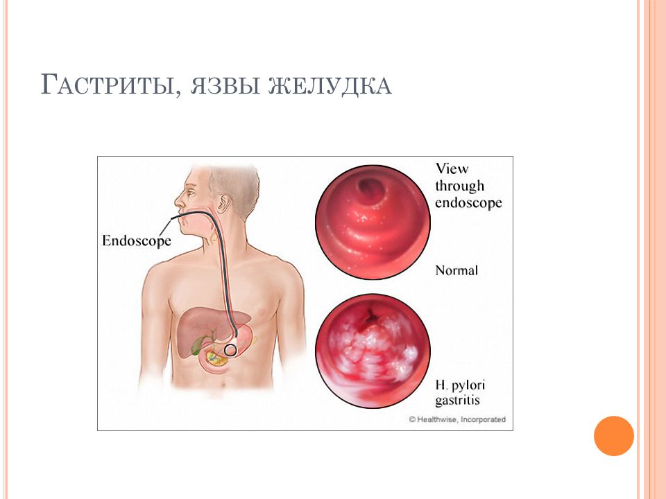 Гастриты у детей презентация