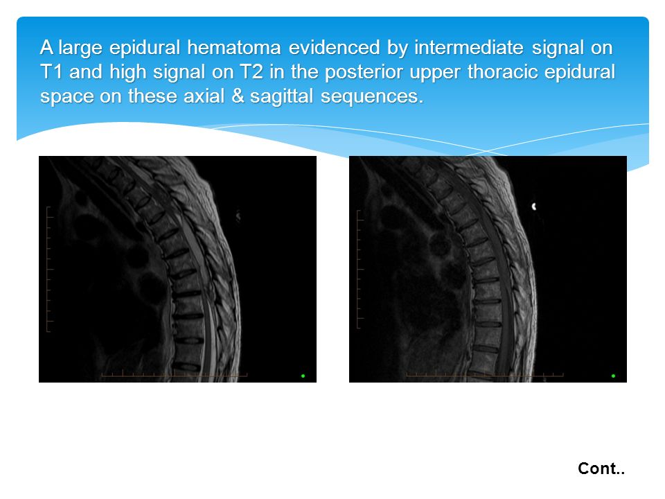 A large epidural hematoma evidenced by intermediate signal on T1 and high signal on T2 in the posterior upper thoracic epidural space on these axial & sagittal sequences.