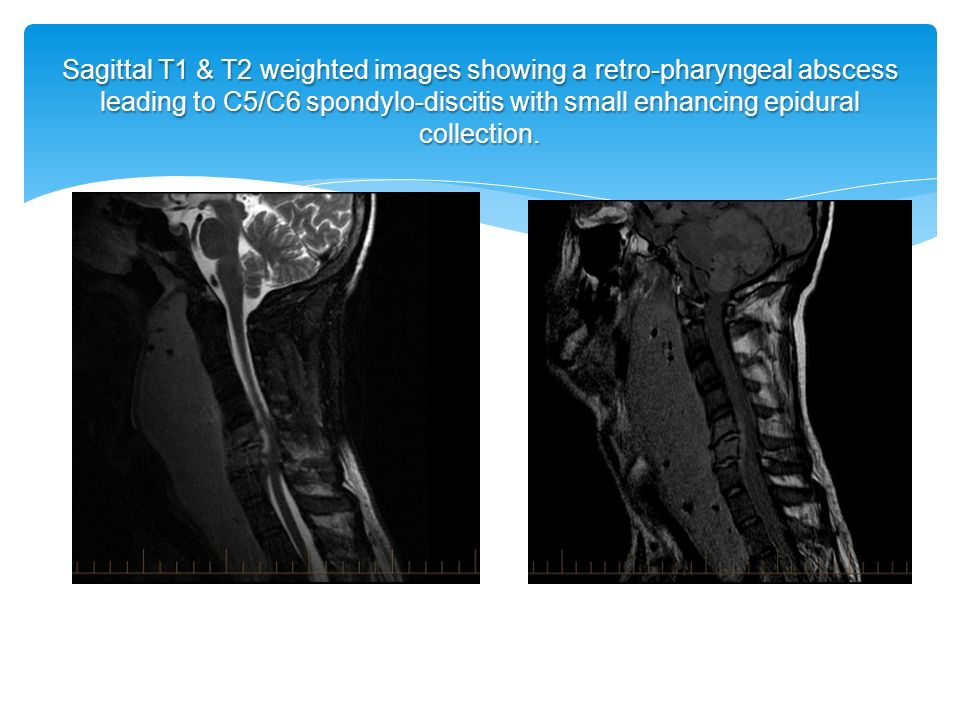 Sagittal T1 & T2 weighted images showing a retro-pharyngeal abscess leading to C5/C6 spondylo-discitis with small enhancing epidural collection.