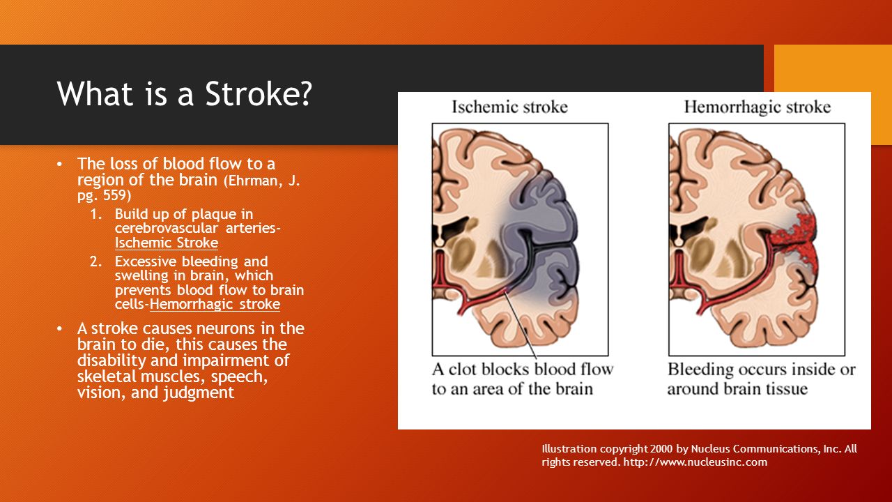What is a Stroke. The loss of blood flow to a region of the brain (Ehrman, J.
