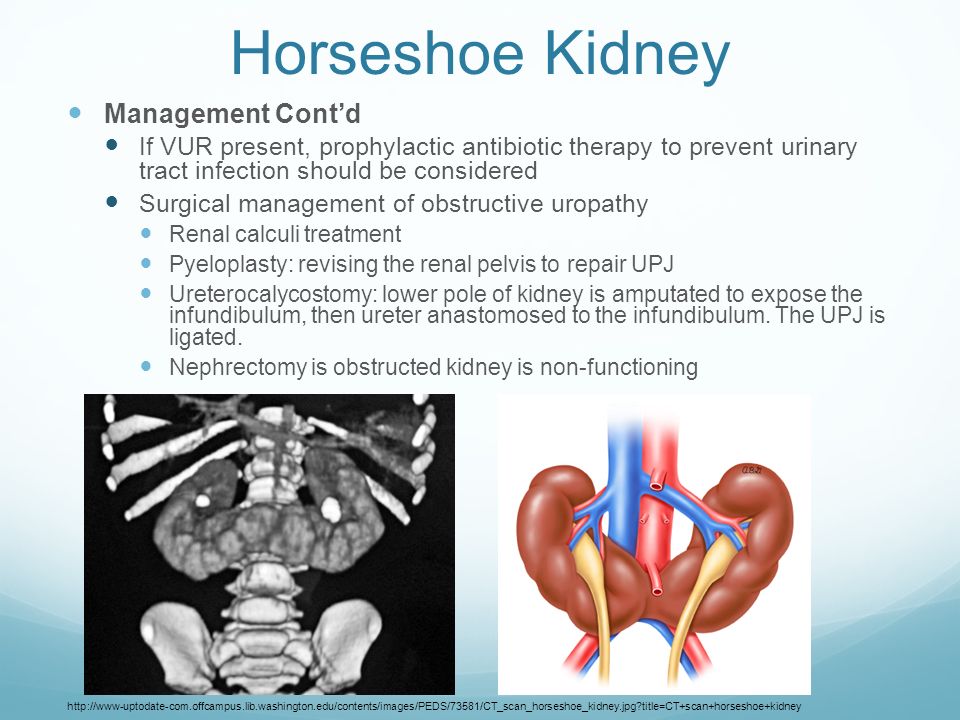 Renal Anomalies In Vacterl Association Chinonyerem Okoro R1 Seattle Children S Hospital General Surgery Rotation August 13 Th Ppt Download