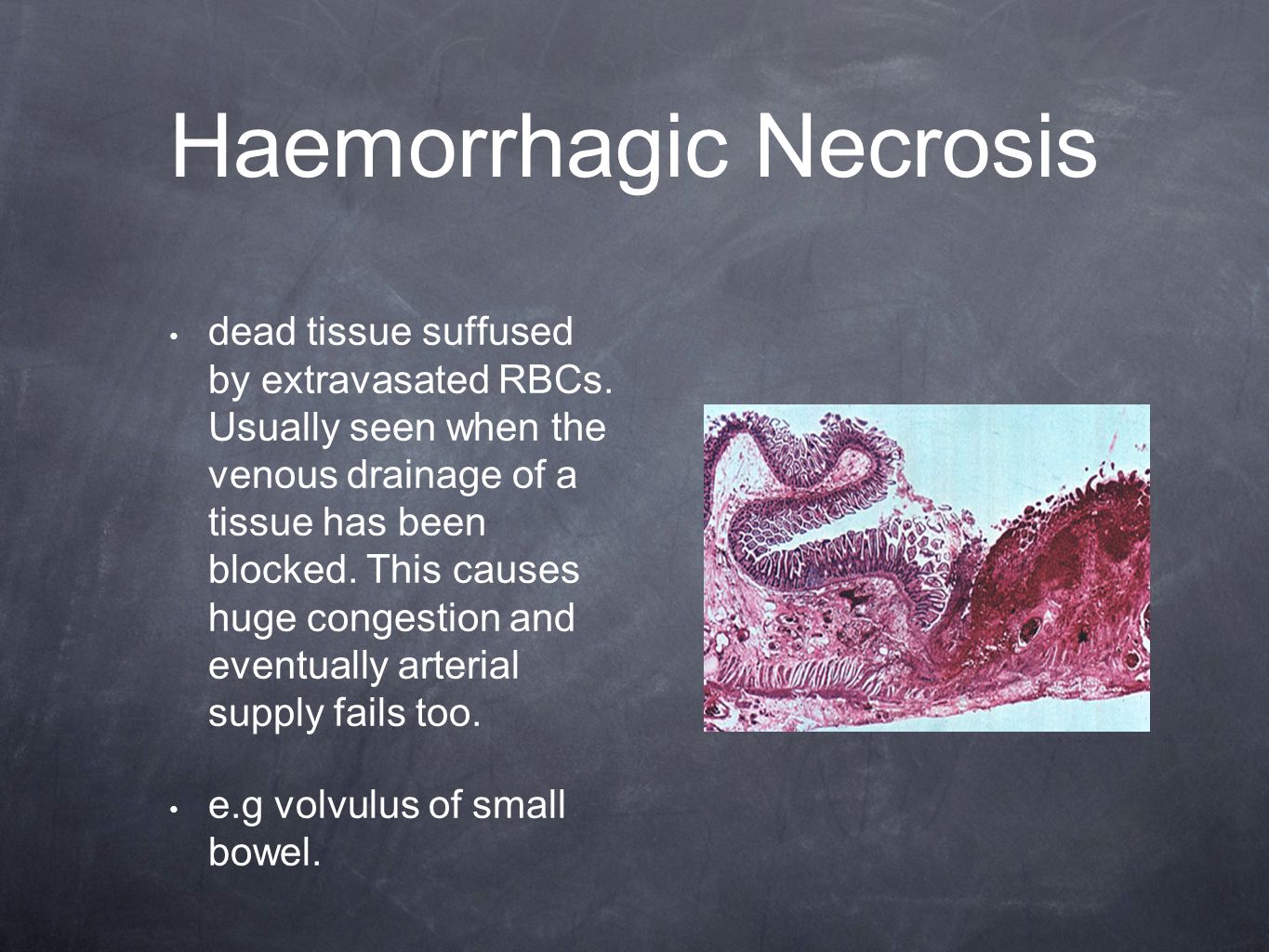Haemorrhagic Necrosis dead tissue suffused by extravasated RBCs.