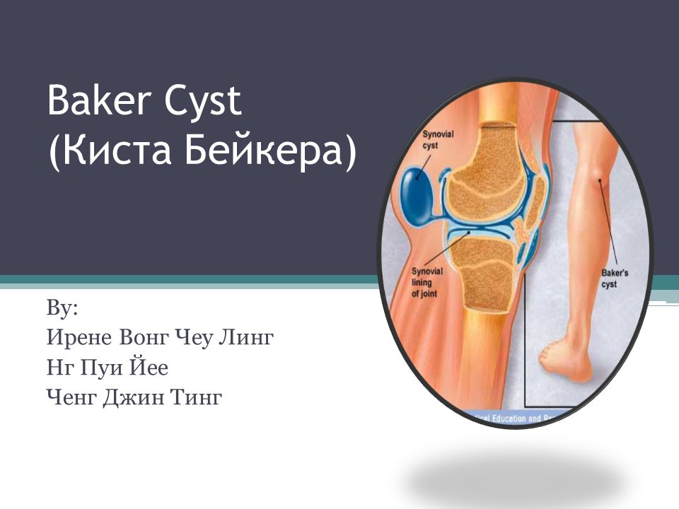 1 Baker Cyst D0 Ba D0 B8 D1 81 D1 82 D0 B0 D0 B1 D0 B5 D0 B9 D0 Ba D0 B5 D1 80 D0 B0 By D0 B8 D1 80 D0 B5 D0 Bd D0 B5 D0 B2 D0 Be D0 Bd D0 B3 D1 87 D0 B5 D1 83 D0 Bb D0 B8 D0 Bd D0 B3 D0 Bd 1 Baker Cyst D0 Ba D0 B8 D1 81 D1 82 D0 B0 D0 B1 D0 B5 D0 B9 D0 Ba D0 B5 D1 80 D0 B0 By D0 B8 D1 80 D0 B5 D0 Bd D0 B5 D0 B2 D0 Be D0 Bd D0 B3 D1 87 D0 B5 D1 83 D0 Bb D0 B8 D0 Bd D0 B3 D0 Bd